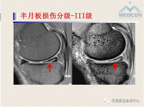 影像PPT - 【PPT】半月板常见病变及正常变异的MRI诊断-12