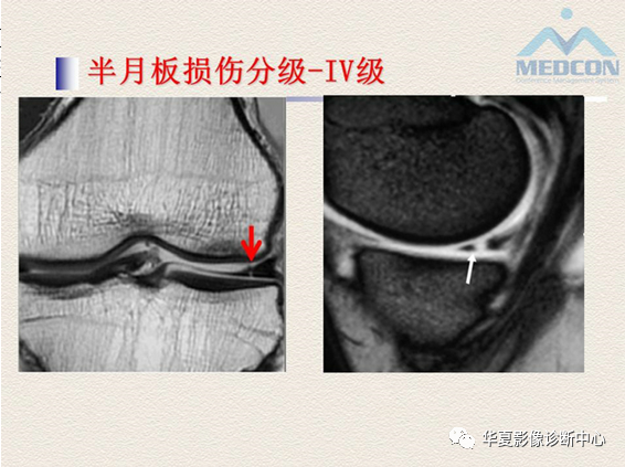 影像PPT - 【PPT】半月板常见病变及正常变异的MRI诊断-13