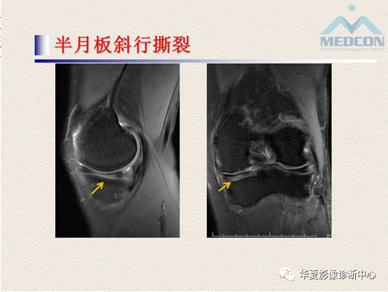 影像PPT - 【PPT】半月板常见病变及正常变异的MRI诊断-18