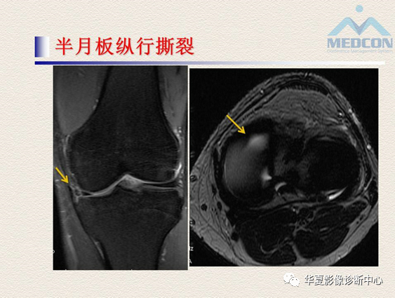 影像PPT - 【PPT】半月板常见病变及正常变异的MRI诊断-20