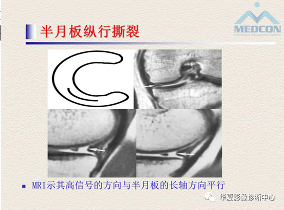 影像PPT - 【PPT】半月板常见病变及正常变异的MRI诊断-19