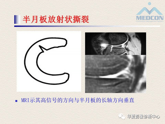 影像PPT - 【PPT】半月板常见病变及正常变异的MRI诊断-21