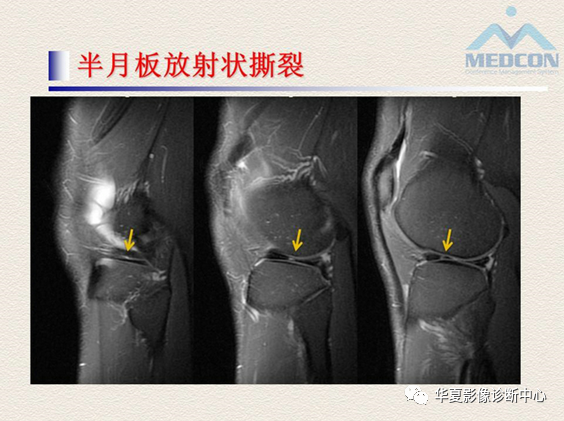 影像PPT - 【PPT】半月板常见病变及正常变异的MRI诊断-22