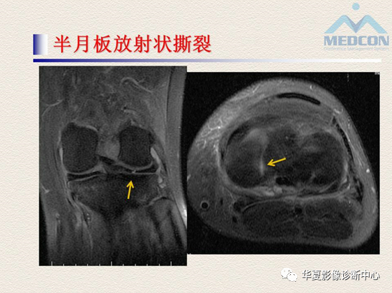 影像PPT - 【PPT】半月板常见病变及正常变异的MRI诊断-23