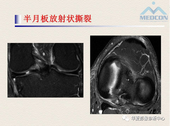 影像PPT - 【PPT】半月板常见病变及正常变异的MRI诊断-24