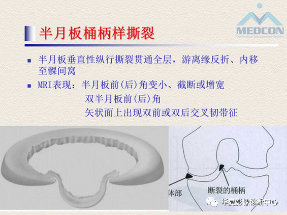 影像PPT - 【PPT】半月板常见病变及正常变异的MRI诊断-25
