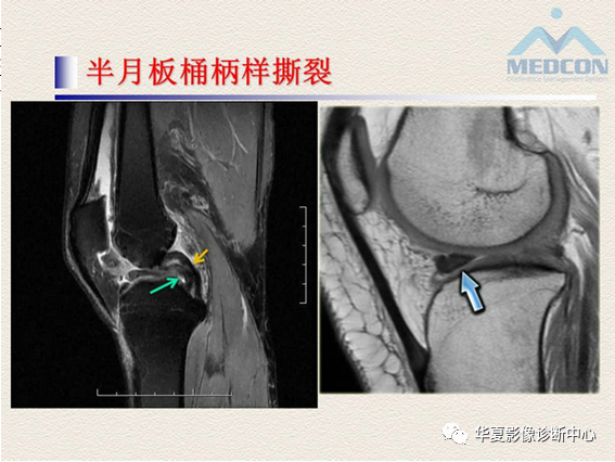影像PPT - 【PPT】半月板常见病变及正常变异的MRI诊断-26