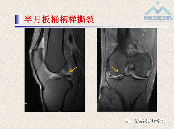 影像PPT - 【PPT】半月板常见病变及正常变异的MRI诊断-27