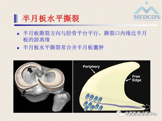 影像PPT - 【PPT】半月板常见病变及正常变异的MRI诊断-28