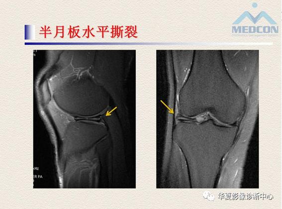 影像PPT - 【PPT】半月板常见病变及正常变异的MRI诊断-29