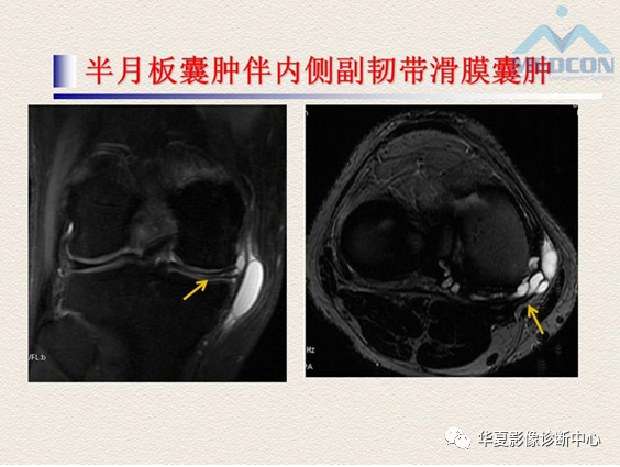 影像PPT - 【PPT】半月板常见病变及正常变异的MRI诊断-30
