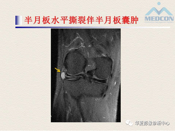 影像PPT - 【PPT】半月板常见病变及正常变异的MRI诊断-31