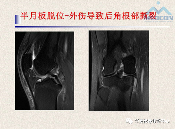 影像PPT - 【PPT】半月板常见病变及正常变异的MRI诊断-33