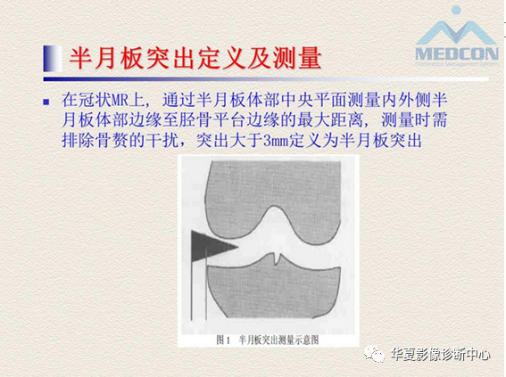 影像PPT - 【PPT】半月板常见病变及正常变异的MRI诊断-34