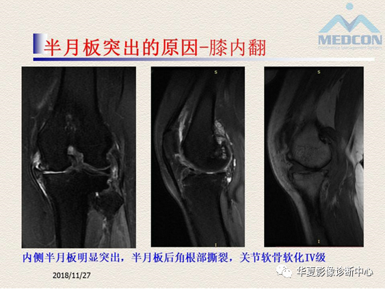 影像PPT - 【PPT】半月板常见病变及正常变异的MRI诊断-36