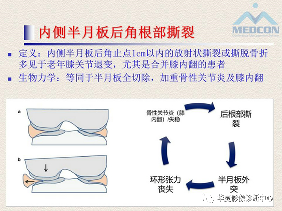 影像PPT - 【PPT】半月板常见病变及正常变异的MRI诊断-37