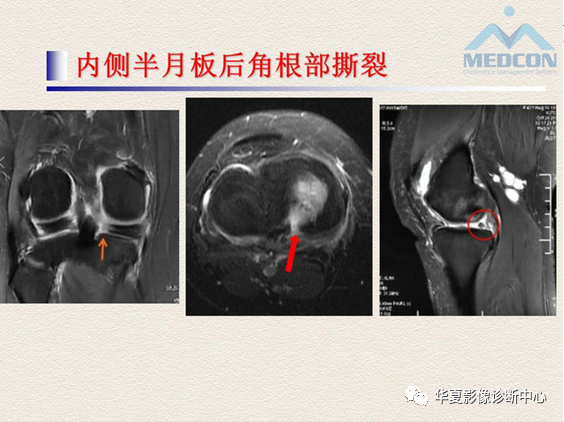 影像PPT - 【PPT】半月板常见病变及正常变异的MRI诊断-38