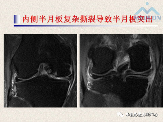 影像PPT - 【PPT】半月板常见病变及正常变异的MRI诊断-39
