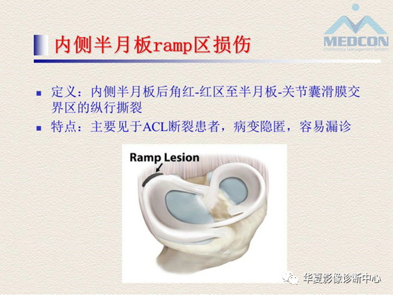 影像PPT - 【PPT】半月板常见病变及正常变异的MRI诊断-41
