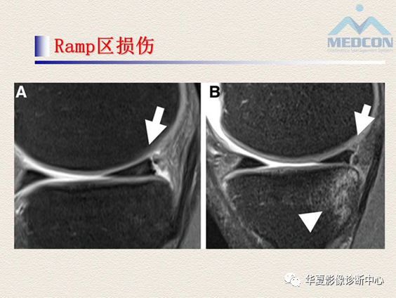 影像PPT - 【PPT】半月板常见病变及正常变异的MRI诊断-42