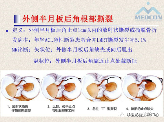 影像PPT - 【PPT】半月板常见病变及正常变异的MRI诊断-43