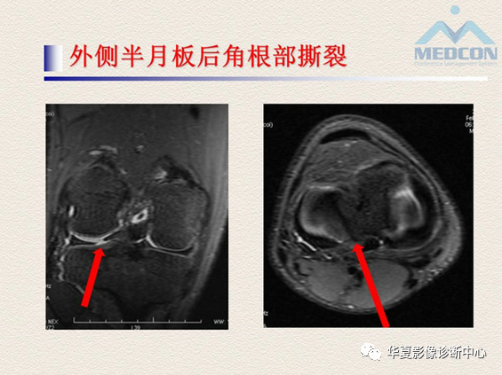 影像PPT - 【PPT】半月板常见病变及正常变异的MRI诊断-44