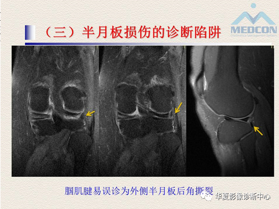影像PPT - 【PPT】半月板常见病变及正常变异的MRI诊断-45