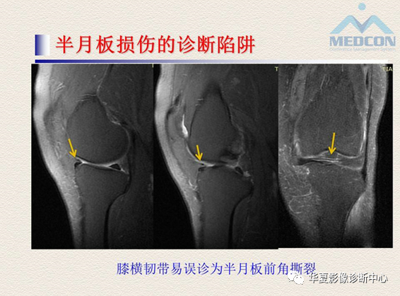 影像PPT - 【PPT】半月板常见病变及正常变异的MRI诊断-46