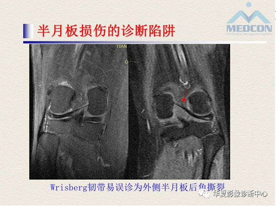 影像PPT - 【PPT】半月板常见病变及正常变异的MRI诊断-47