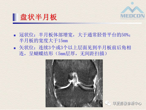 影像PPT - 【PPT】半月板常见病变及正常变异的MRI诊断-49