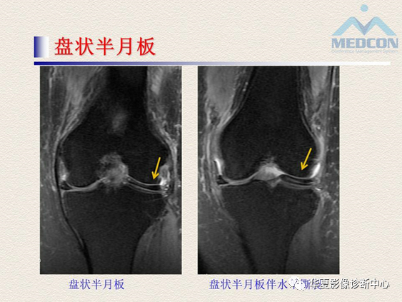 影像PPT - 【PPT】半月板常见病变及正常变异的MRI诊断-50