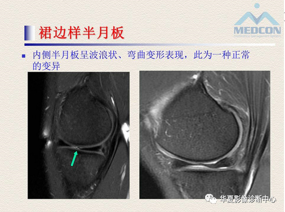 影像PPT - 【PPT】半月板常见病变及正常变异的MRI诊断-51