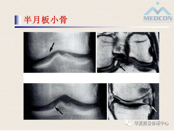 影像PPT - 【PPT】半月板常见病变及正常变异的MRI诊断-53