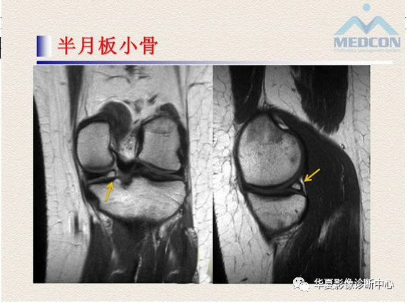 影像PPT - 【PPT】半月板常见病变及正常变异的MRI诊断-54