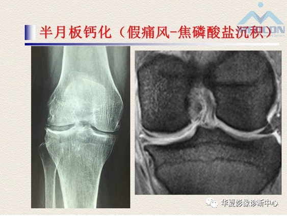 影像PPT - 【PPT】半月板常见病变及正常变异的MRI诊断-55