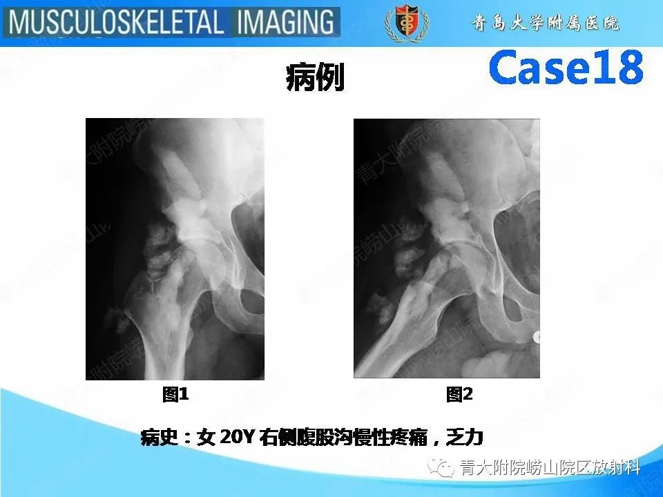 影像PPT - 【PPT】蜡泪样骨病-2
