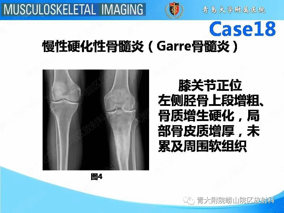 影像PPT - 【PPT】蜡泪样骨病-6