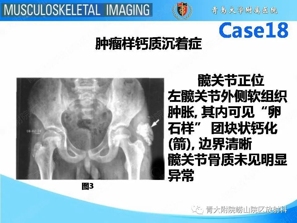 影像PPT - 【PPT】蜡泪样骨病-5