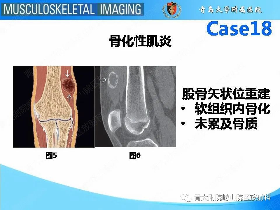 影像PPT - 【PPT】蜡泪样骨病-7
