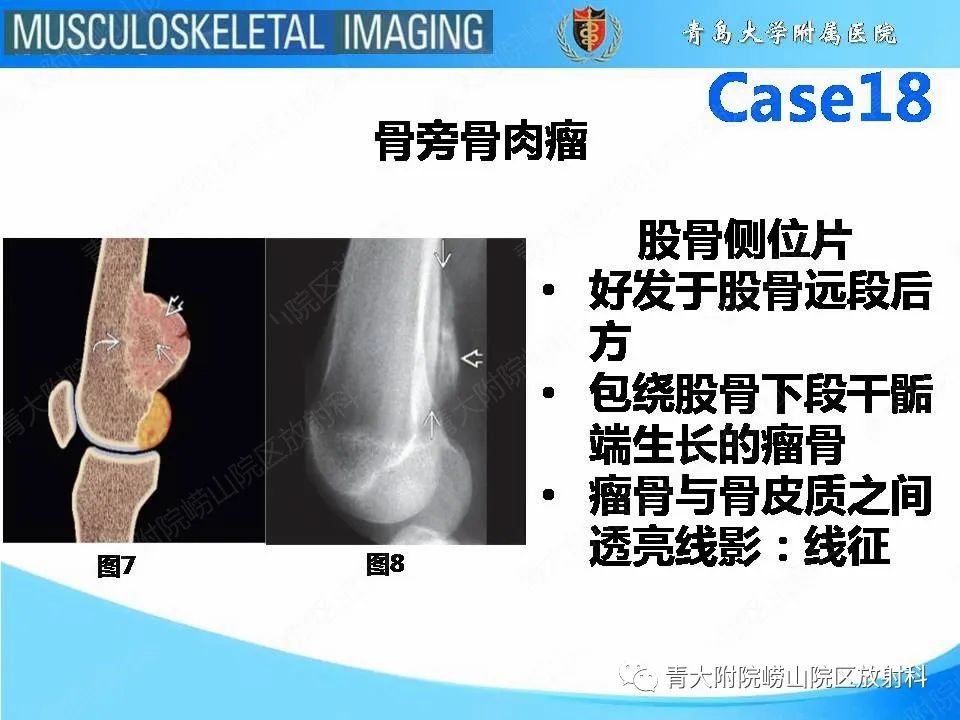 影像PPT - 【PPT】蜡泪样骨病-8