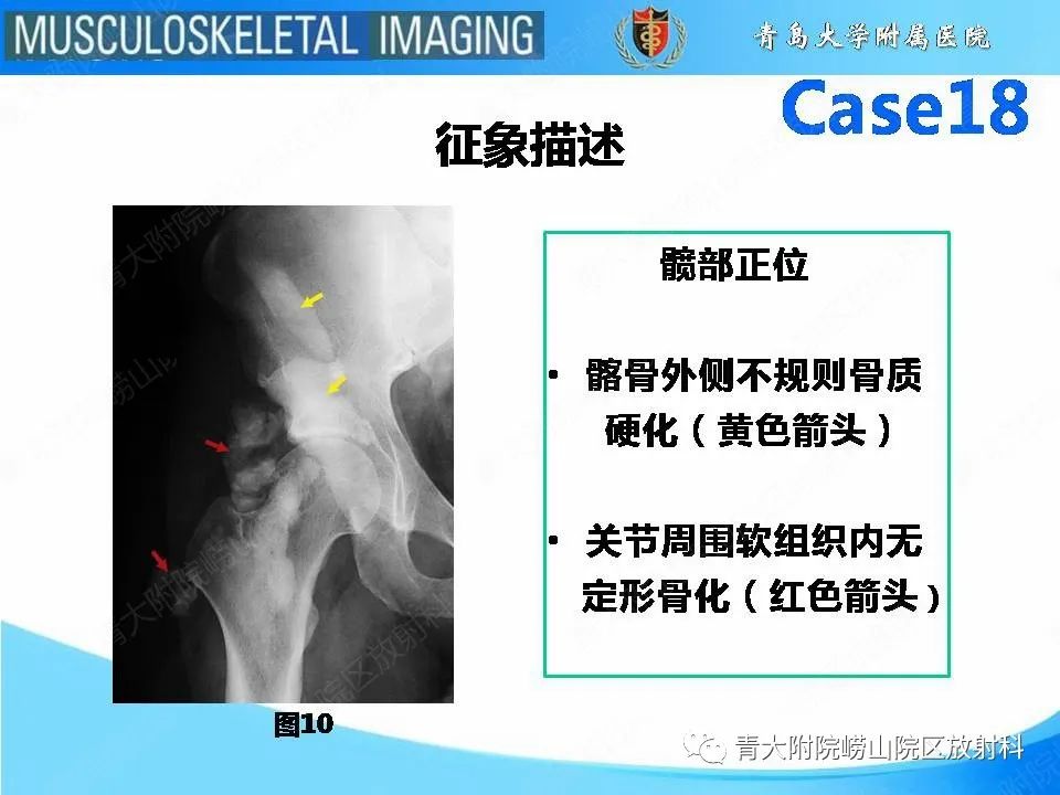 影像PPT - 【PPT】蜡泪样骨病-15