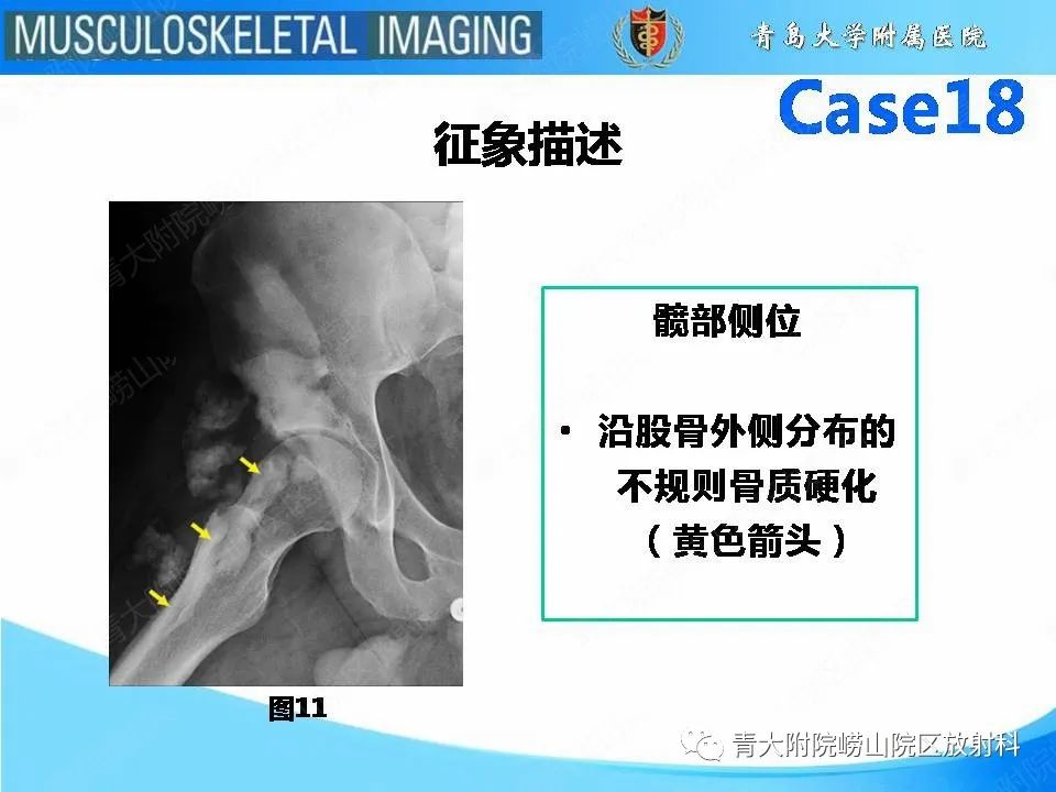 影像PPT - 【PPT】蜡泪样骨病-16