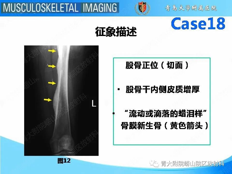 影像PPT - 【PPT】蜡泪样骨病-17