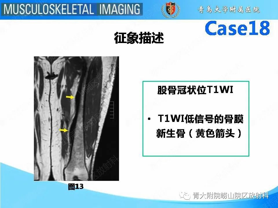 影像PPT - 【PPT】蜡泪样骨病-18