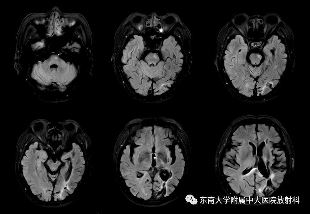 影像PPT - 【PPT】华勒变性-1