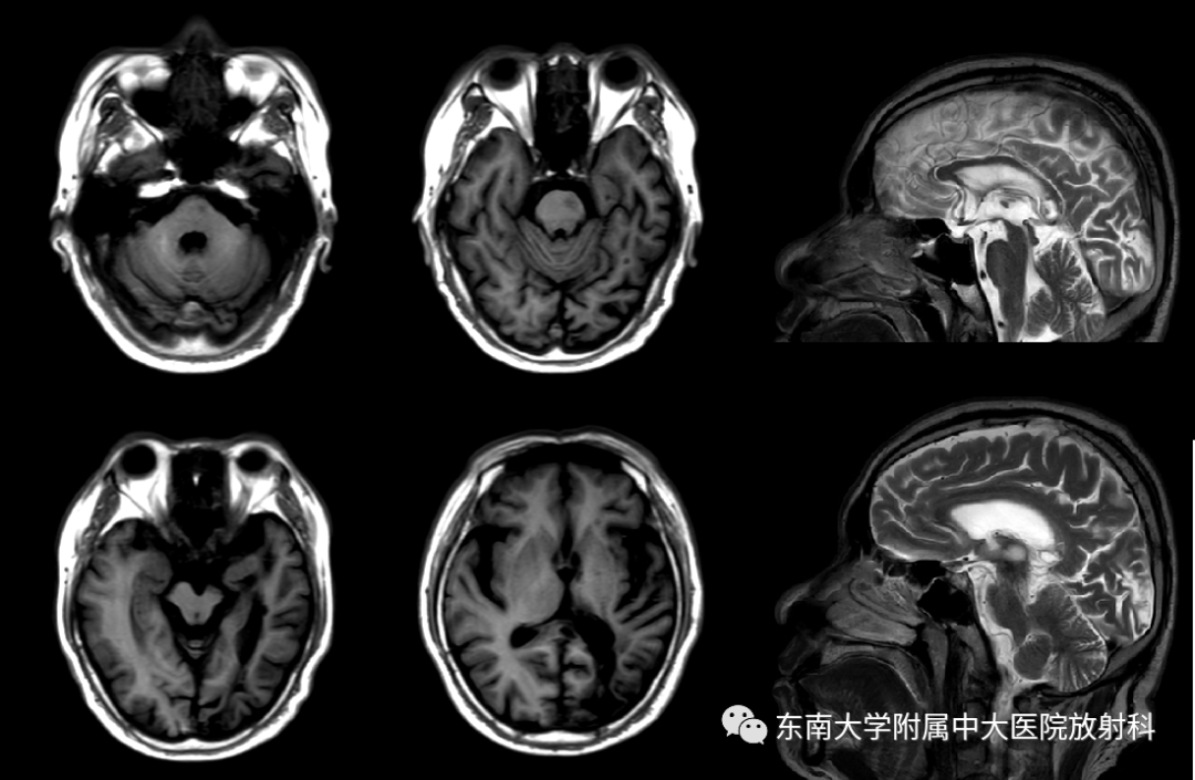 影像PPT - 【PPT】华勒变性-2