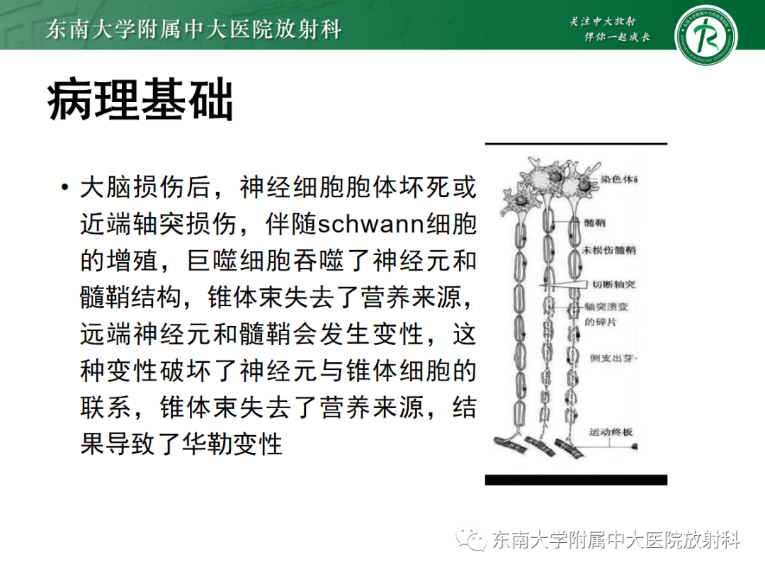 影像PPT - 【PPT】华勒变性-8
