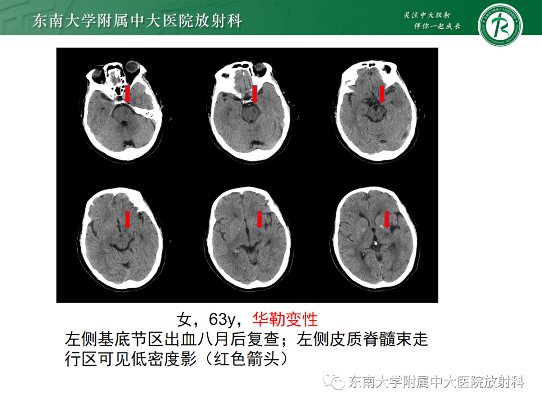 影像PPT - 【PPT】华勒变性-14