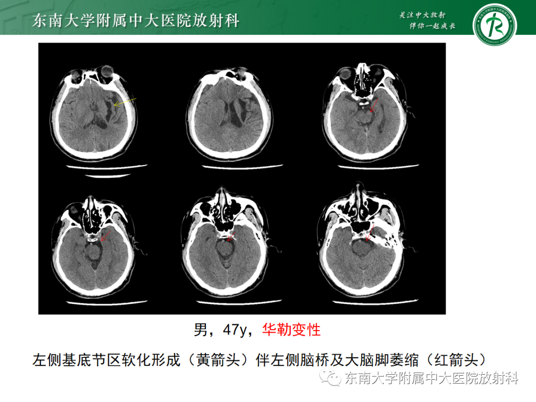影像PPT - 【PPT】华勒变性-15
