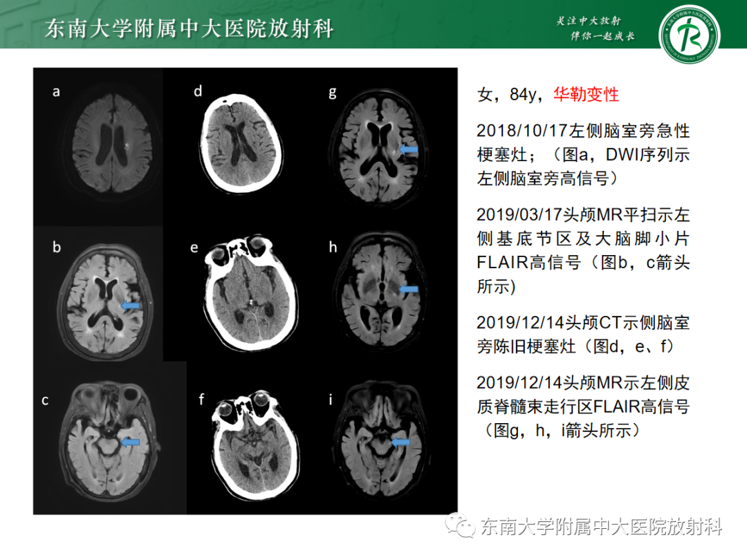 影像PPT - 【PPT】华勒变性-18
